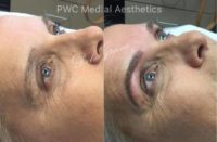 55-64 year old woman treated with Microblading