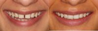 35-44 year old woman treated with Invisible Braces OrthoSnap