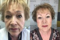65-74 year old woman treated with Juvederm Ultra Plus