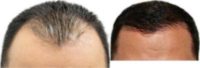 35-44 year old woman treated with ARTAS Robotic Hair Transplant