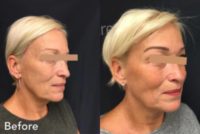 Woman treated with Skin Tightening