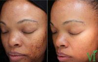 25-34 year old woman treated with Vi Peel