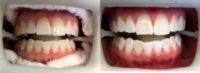 25-34 year old woman treated with Teeth Whitening