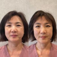 45-54 year old woman treated with Dermal Fillers