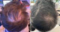 35-44 year old man treated with PRP for Hair Loss