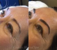 Woman treated with Microblading