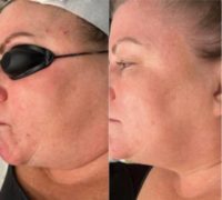45-54 year old woman treated with CoolPeel