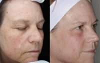 55-64 year old woman treated with Skin Rejuvenation