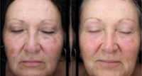 35-44 year old woman treated with Skin Rejuvenation