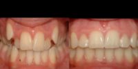 35-44 year old woman treated with clear teeth aligners OrthoSnap.