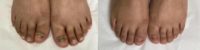 25-34 year old woman treated with Laser Toenail Fungus Removal