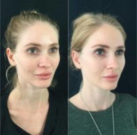 25-34 year old woman treated with Sculptra Aesthetic