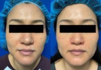 35-44 year old woman treated with PicoSure