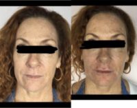 45-54 year old woman treated with fillers