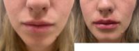 Facial balancing and Lip augmentation