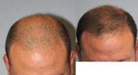 45-54 year old man treated with PRP Hair Restoration
