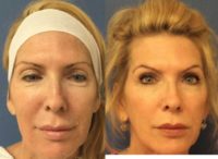 55-64 year old woman treated with Upper Eyelid Blepharoplasty