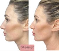 Woman treated with Chin Filler, Dermal Fillers