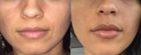 35-44 year old woman treated with Juvederm