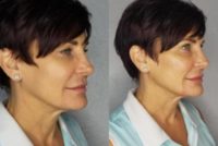45-54 year old woman treated with Radiesse Injectable Fillers