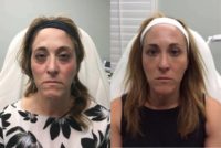 47 year old woman treated with Dermal Fillers