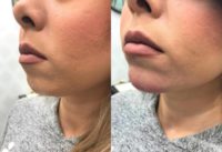 25-34 year old woman treated with Restylane Lyft for non-surgical chin augmentation