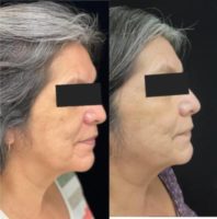 55-64 year old woman treated with AviClear