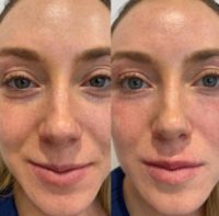 25-34 year old woman results Under Eye / Tear Trough Filler