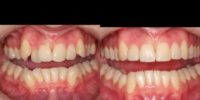 25-34 year old man treated with clear braces OrthoSnap