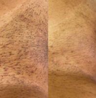 18-24 year old woman treated with Laser Hair Removal