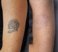 Person treated with Tattoo Removal