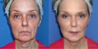 Woman treated with Liquid Facelift