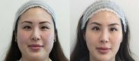 Facial Contouring with Botox and fillers