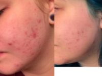 18-24 year old woman treated with Skin Rejuvenation
