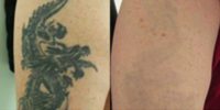 35-44 year old man treated with Tattoo Removal