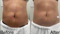 Woman treated with truSculpt