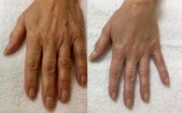 Hand Rejuvenation with Radiesse dermal filler