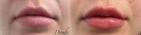 Woman treated with Lip Fillers, Restylane