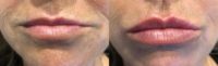 Lip Enhancement with Volbella