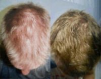 Man treated with Hair Loss Treatment