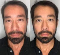Man treated with Sculptra Aesthetic