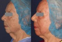 Woman treated with Laser Resurfacing