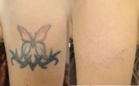 Woman treated with Tattoo Removal