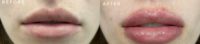 Woman treated with Lip Fillers