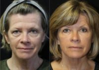 Treated with Vampire Facelift